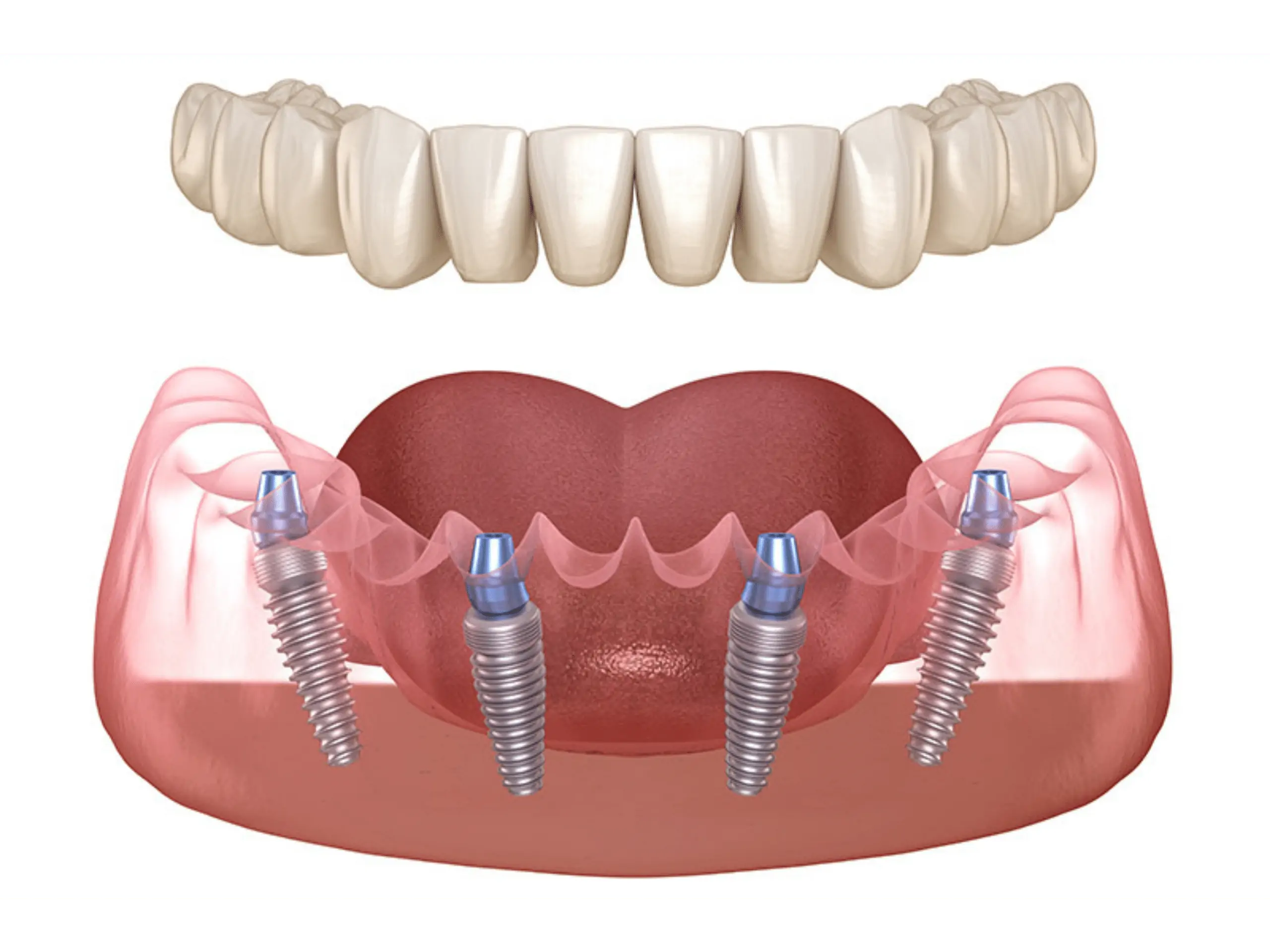 types of dental implants cost